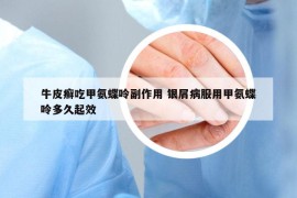 牛皮癬吃甲氨蝶呤副作用 銀屑病服用甲氨蝶呤多久起效