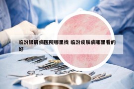 臨汾銀屑病醫(yī)院哪里找 臨汾皮膚病哪里看的好