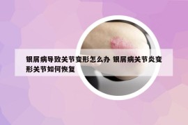 銀屑病導(dǎo)致關(guān)節(jié)變形怎么辦 銀屑病關(guān)節(jié)炎變形關(guān)節(jié)如何恢復(fù)