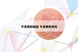 牛皮癬鼓槌指 牛皮癬鼓包嗎