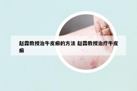 趙霖教授治牛皮癬的方法 趙霖教授治療牛皮癬
