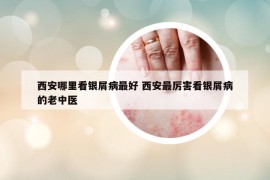西安哪里看銀屑病最好 西安最厲害看銀屑病的老中醫(yī)