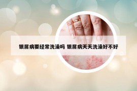 銀屑病要經(jīng)常洗澡嗎 銀屑病天天洗澡好不好