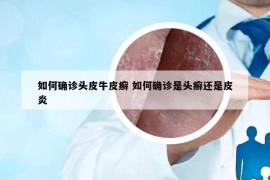 如何確診頭皮牛皮癬 如何確診是頭癬還是皮炎