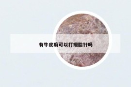 有牛皮癬可以打瘦臉針嗎