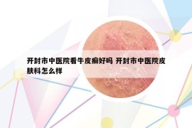 開封市中醫(yī)院看牛皮癬好嗎 開封市中醫(yī)院皮膚科怎么樣