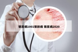 銀屑病1001銀削病 銀屑病2020