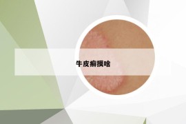 牛皮癬摸啥