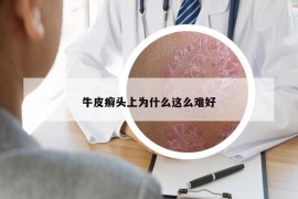 牛皮癬頭上為什么這么難好