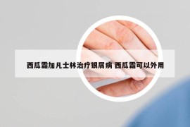 西瓜霜加凡士林治療銀屑病 西瓜霜可以外用