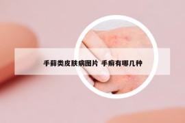 手蘚類皮膚病圖片 手癬有哪幾種