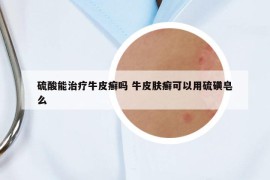 硫酸能治療牛皮癬嗎 牛皮膚癬可以用硫磺皂么