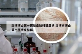 淄博博山第一醫(yī)院皮膚科銀屑病 淄博市博山第一醫(yī)院皮膚科