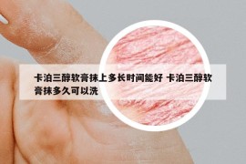 卡泊三醇軟膏抹上多長(zhǎng)時(shí)間能好 卡泊三醇軟膏抹多久可以洗