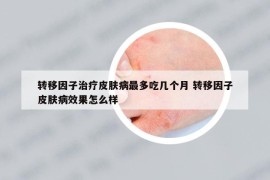 轉(zhuǎn)移因子治療皮膚病最多吃幾個(gè)月 轉(zhuǎn)移因子皮膚病效果怎么樣