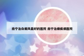 南寧治白癜風最好的醫(yī)院 南寧治癲瘋病醫(yī)院