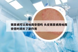 銀屑病可以用哈西奈德嗎 頭皮銀屑病用哈西奈德時間長了副作用
