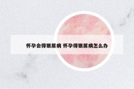 懷孕會(huì)得銀屑病 懷孕得銀屑病怎么辦