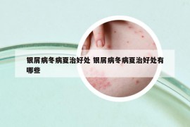 銀屑病冬病夏治好處 銀屑病冬病夏治好處有哪些