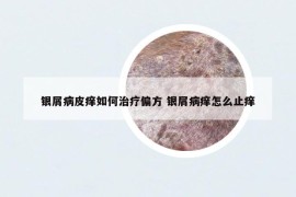 銀屑病皮癢如何治療偏方 銀屑病癢怎么止癢