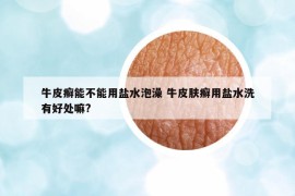 牛皮癬能不能用鹽水泡澡 牛皮膚癬用鹽水洗有好處嘛?
