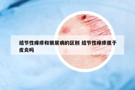 結節(jié)性癢疹和銀屑病的區(qū)別 結節(jié)性癢疹屬于皮炎嗎