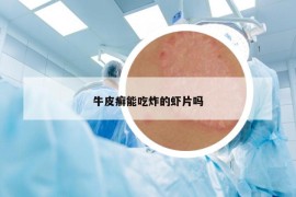 牛皮癬能吃炸的蝦片嗎
