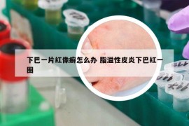 下巴一片紅像癬怎么辦 脂溢性皮炎下巴紅一圈