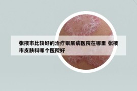 張掖市比較好的治療銀屑病醫(yī)院在哪里 張掖市皮膚科哪個醫(yī)院好