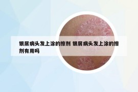 銀屑病頭發(fā)上涂的擦劑 銀屑病頭發(fā)上涂的擦劑有用嗎