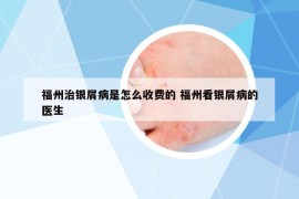 福州治銀屑病是怎么收費的 福州看銀屑病的醫(yī)生