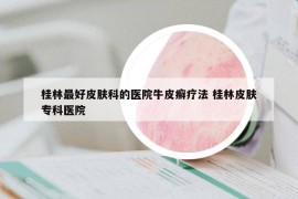桂林最好皮膚科的醫(yī)院牛皮癬療法 桂林皮膚?？漆t(yī)院