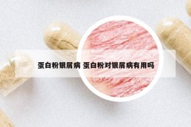 蛋白粉銀屑病 蛋白粉對銀屑病有用嗎