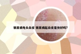 銀屑病龜頭白皮 銀屑病起白皮是快好嗎?