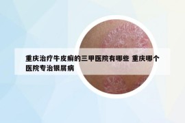 重慶治療牛皮癬的三甲醫(yī)院有哪些 重慶哪個(gè)醫(yī)院專治銀屑病