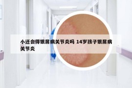 小還會(huì)得銀屑病關(guān)節(jié)炎嗎 14歲孩子銀屑病關(guān)節(jié)炎