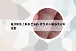 青少年頭上長(zhǎng)癬怎么辦 青少年頭癬多久可以治愈