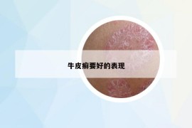 牛皮癬要好的表現(xiàn)