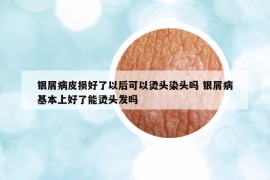 銀屑病皮損好了以后可以燙頭染頭嗎 銀屑病基本上好了能燙頭發(fā)嗎