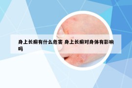 身上長癬有什么危害 身上長癬對身體有影響嗎