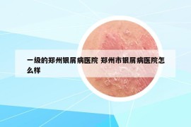 一級的鄭州銀屑病醫(yī)院 鄭州市銀屑病醫(yī)院怎么樣