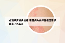 點(diǎn)滴銀屑病頭皮癢 銀屑病頭皮癢得很厲害抓破皮了怎么辦
