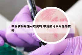 牛皮膚癬用醋可以洗嗎 牛皮廨可以用醋擦拭嗎