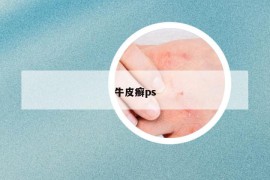 牛皮癬ps
