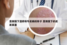 顯微鏡下濕疹和牛皮癬的樣子 顯微鏡下的皮屑真菌