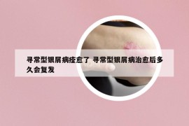 尋常型銀屑病痊愈了 尋常型銀屑病治愈后多久會復(fù)發(fā)