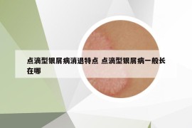 點滴型銀屑病消退特點 點滴型銀屑病一般長在哪