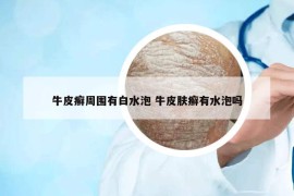 牛皮癬周圍有白水泡 牛皮膚癬有水泡嗎