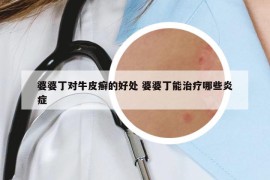 婆婆丁對牛皮癬的好處 婆婆丁能治療哪些炎癥