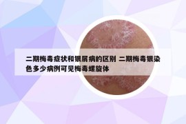二期梅毒癥狀和銀屑病的區(qū)別 二期梅毒銀染色多少病例可見梅毒螺旋體
